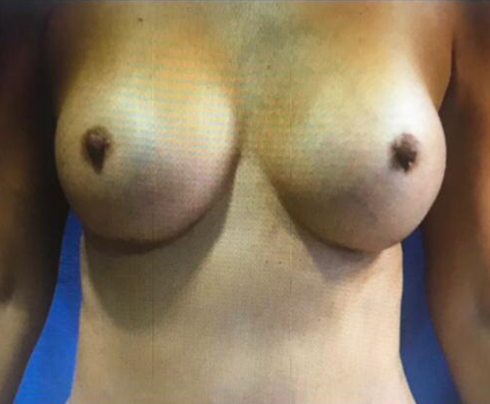 After-Aumento Mamario