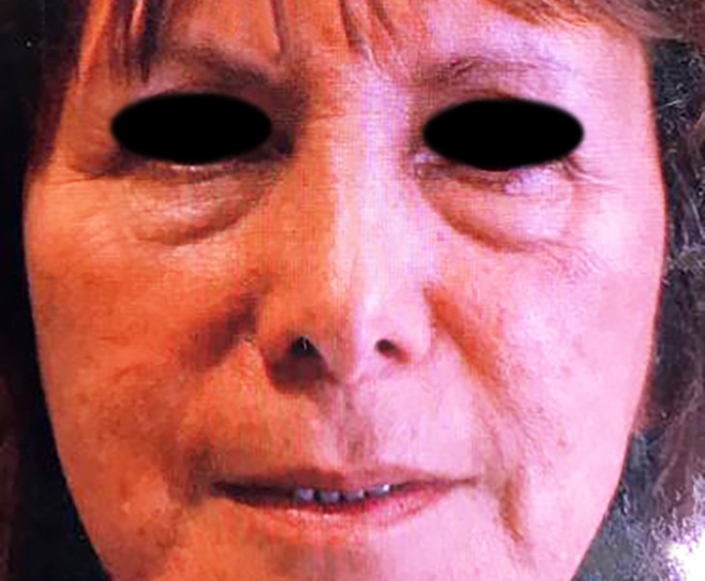 Before-Blefaroplastia