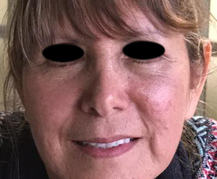 After-Blefaroplastia