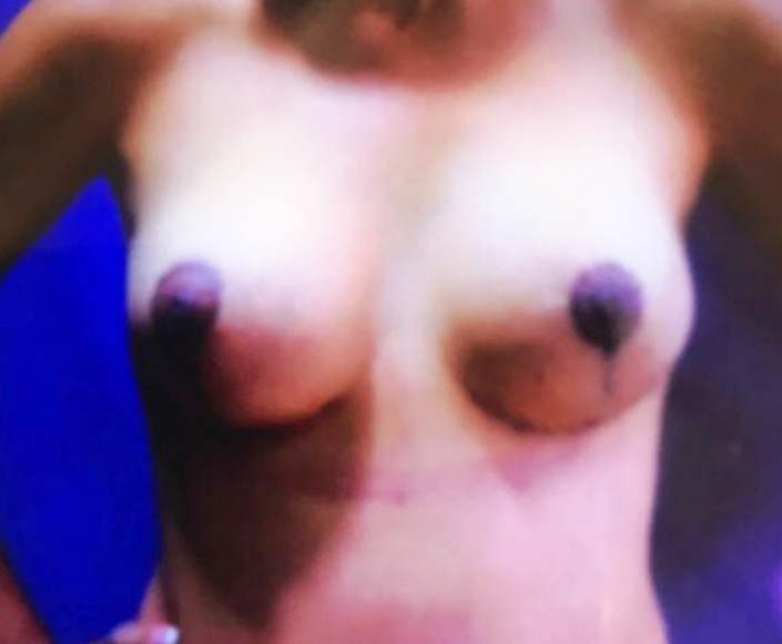 After-Reducción Mamaria